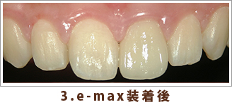 3.e-max装着後